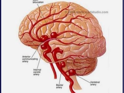 交通事故と脳内出血の因果関係