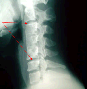 頚椎前方固定術後の変性画像と固定術の後遺障害